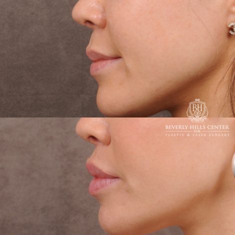 Beverly Hills Center Female Patient Before and After CUPID LIFT® Lip Lift