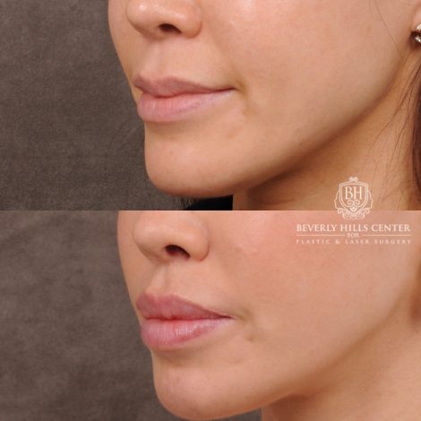 Beverly Hills Center Female Patient Before and After CUPID LIFT® Lip Lift