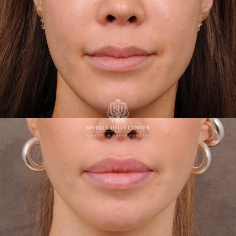 Beverly Hills Center Female Patient Before and After CUPID LIFT® Lip Lift