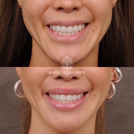 Beverly Hills Center Female Patient Before and After CUPID LIFT® Lip Lift