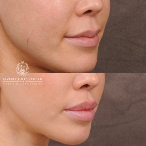 Beverly Hills Center Female Patient Before and After CUPID LIFT® Lip Lift