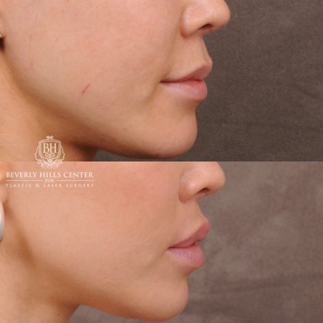 Beverly Hills Center Female Patient Before and After CUPID LIFT® Lip Lift