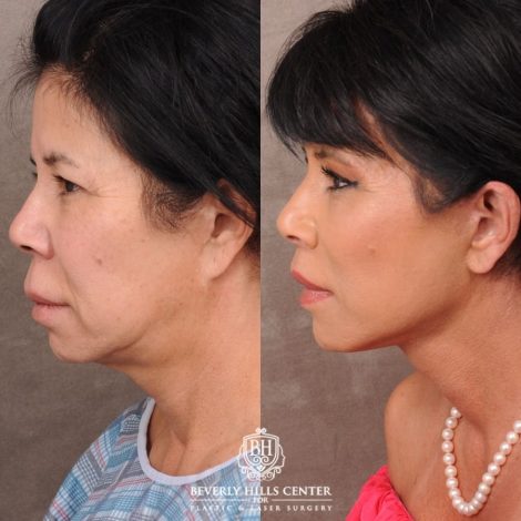 Beverly Hills Center Female Patient Before and After AuraLyft, Upper Blepharoplasty, Temporal Brow Reset, CUPID LIFT® Lip Lift