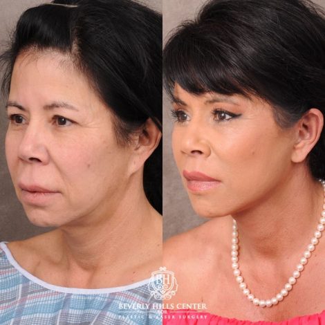 Beverly Hills Center Female Patient Before and After AuraLyft, Upper Blepharoplasty, Temporal Brow Reset, CUPID LIFT® Lip Lift