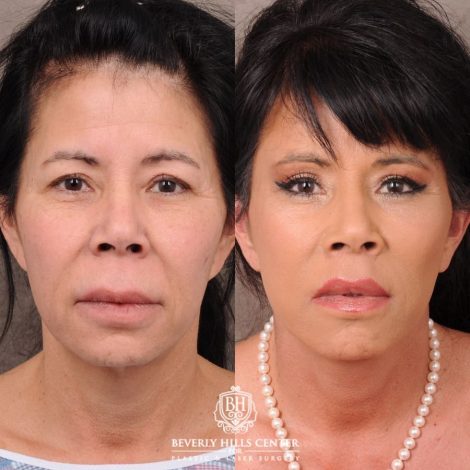 Beverly Hills Center Female Patient Before and After AuraLyft, Upper Blepharoplasty, Temporal Brow Reset, CUPID LIFT® Lip Lift