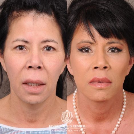 Beverly Hills Center Female Patient Before and After AuraLyft, Upper Blepharoplasty, Temporal Brow Reset, CUPID LIFT® Lip Lift