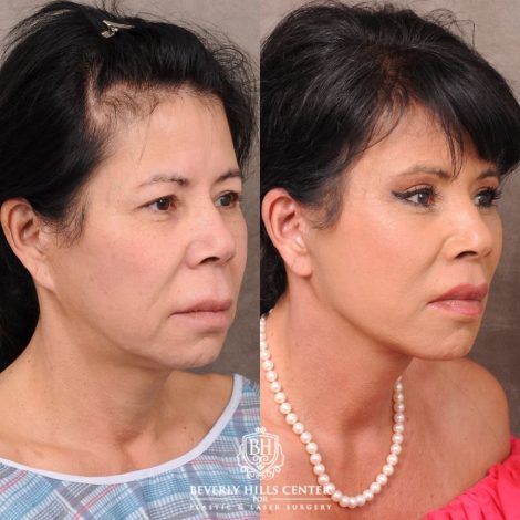 Beverly Hills Center Female Patient Before and After AuraLyft, Upper Blepharoplasty, Temporal Brow Reset, CUPID LIFT® Lip Lift