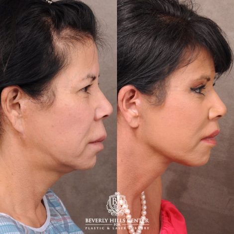 Beverly Hills Center Female Patient Before and After AuraLyft, Upper Blepharoplasty, Temporal Brow Reset, CUPID LIFT® Lip Lift