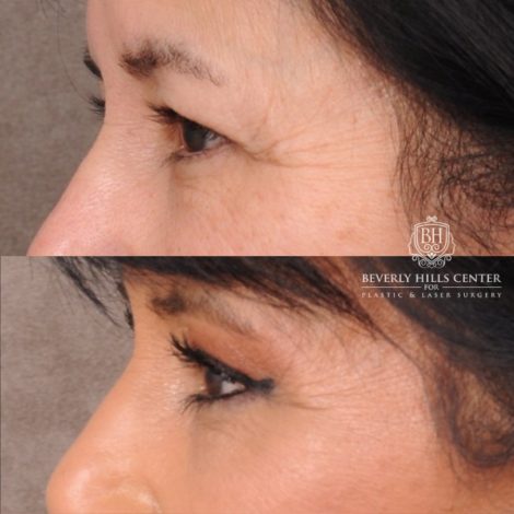 Beverly Hills Center Female Patient Before and After AuraLyft, Upper Blepharoplasty, Temporal Brow Reset, CUPID LIFT® Lip Lift