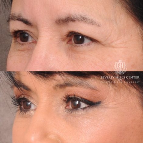 Beverly Hills Center Female Patient Before and After AuraLyft, Upper Blepharoplasty, Temporal Brow Reset, CUPID LIFT® Lip Lift
