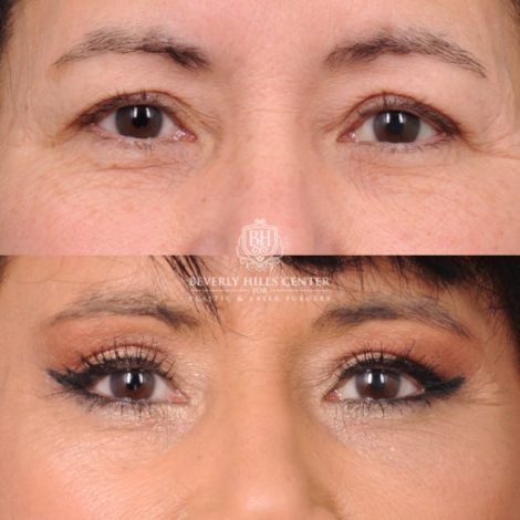 Beverly Hills Center Female Patient Before and After AuraLyft, Upper Blepharoplasty, Temporal Brow Reset, CUPID LIFT® Lip Lift