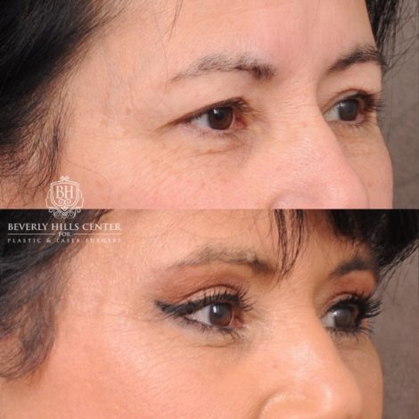 Beverly Hills Center Female Patient Before and After AuraLyft, Upper Blepharoplasty, Temporal Brow Reset, CUPID LIFT® Lip Lift
