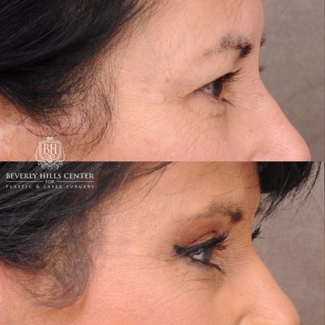 Beverly Hills Center Female Patient Before and After AuraLyft, Upper Blepharoplasty, Temporal Brow Reset, CUPID LIFT® Lip Lift