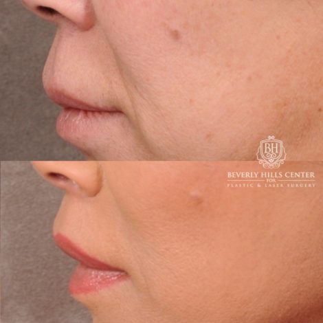 Beverly Hills Center Female Patient Before and After AuraLyft, Upper Blepharoplasty, Temporal Brow Reset, CUPID LIFT® Lip Lift