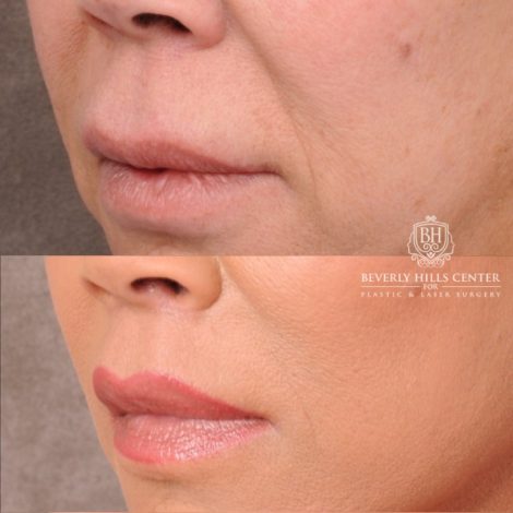 Beverly Hills Center Female Patient Before and After AuraLyft, Upper Blepharoplasty, Temporal Brow Reset, CUPID LIFT® Lip Lift