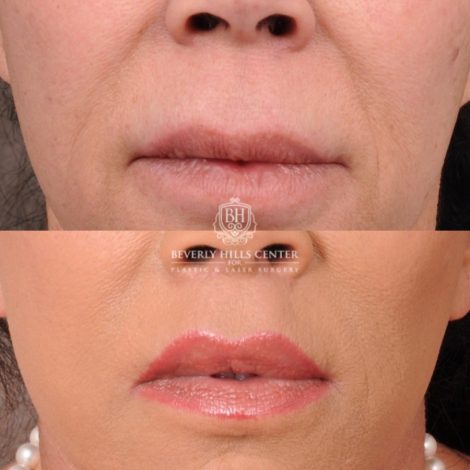 Beverly Hills Center Female Patient Before and After AuraLyft, Upper Blepharoplasty, Temporal Brow Reset, CUPID LIFT® Lip Lift