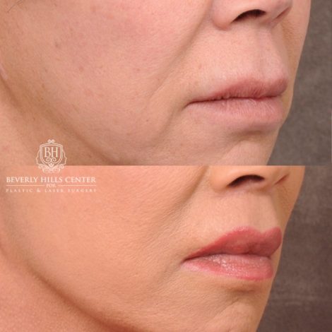 Beverly Hills Center Female Patient Before and After AuraLyft, Upper Blepharoplasty, Temporal Brow Reset, CUPID LIFT® Lip Lift