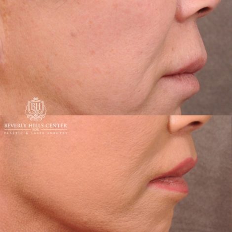 Beverly Hills Center Female Patient Before and After AuraLyft, Upper Blepharoplasty, Temporal Brow Reset, CUPID LIFT® Lip Lift