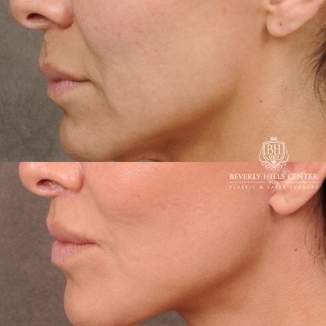 female patient before and after AuraLyft, Weekend Necklift, CUPID LIFT® Lip Lift