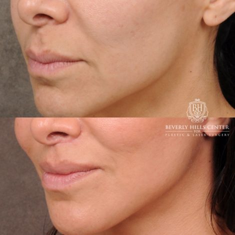 female patient before and after AuraLyft, Weekend Necklift, CUPID LIFT® Lip Lift