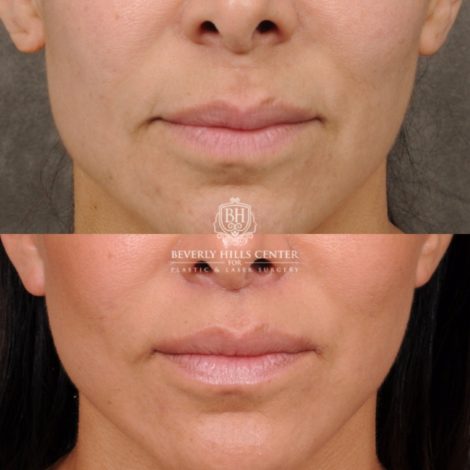 female patient before and after AuraLyft, Weekend Necklift, CUPID LIFT® Lip Lift