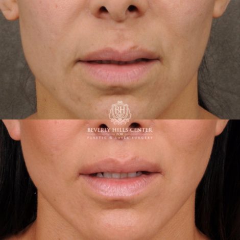 female patient before and after AuraLyft, Weekend Necklift, CUPID LIFT® Lip Lift