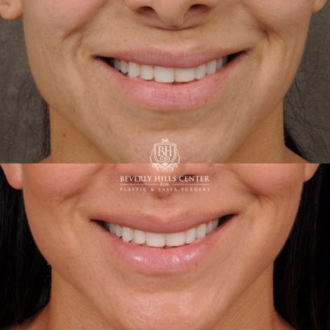 female patient before and after AuraLyft, Weekend Necklift, CUPID LIFT® Lip Lift
