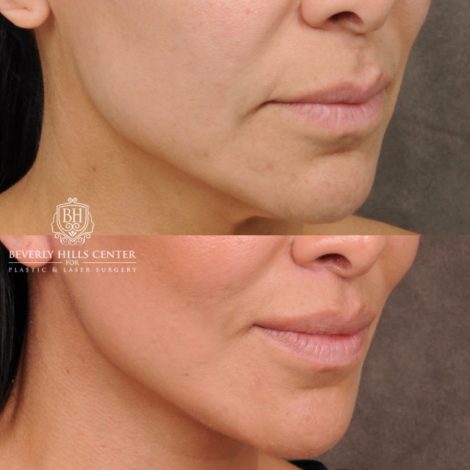 female patient before and after AuraLyft, Weekend Necklift, CUPID LIFT® Lip Lift