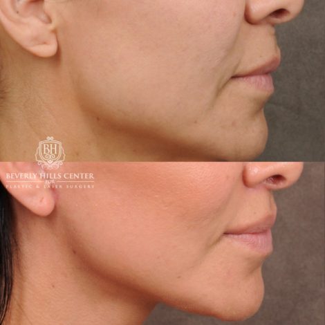 female patient before and after AuraLyft, Weekend Necklift, CUPID LIFT® Lip Lift