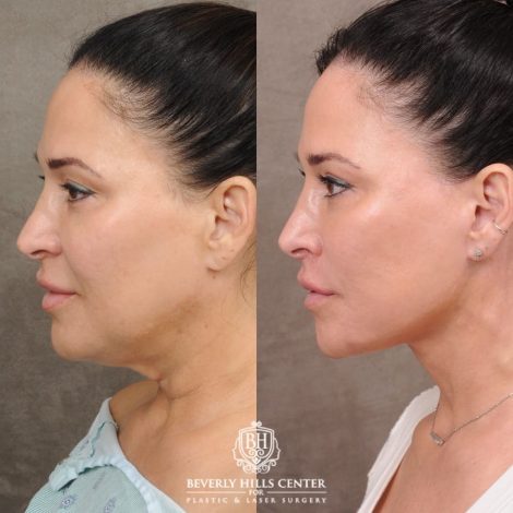 CUPID LIFT® Lip Lift with AuraLyft and Blepharoplasty