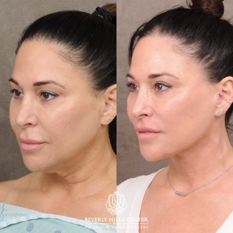 CUPID LIFT® Lip Lift with AuraLyft and Blepharoplasty