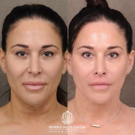 CUPID LIFT® Lip Lift with AuraLyft and Blepharoplasty
