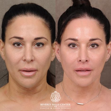 CUPID LIFT® Lip Lift with AuraLyft and Blepharoplasty