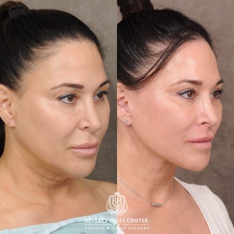 CUPID LIFT® Lip Lift with AuraLyft and Blepharoplasty