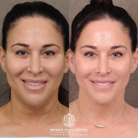 CUPID LIFT® Lip Lift with AuraLyft and Blepharoplasty
