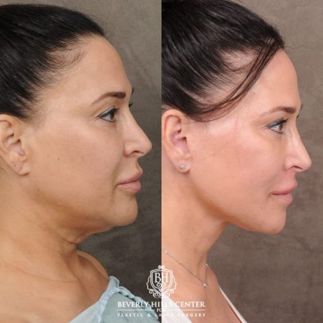 CUPID LIFT® Lip Lift with AuraLyft and Blepharoplasty