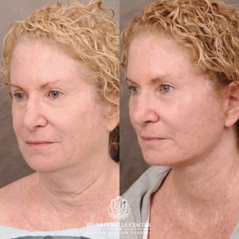 Beverly Hills Center Female Patient Before and After AuraLyft, Upper Blepharoplasty