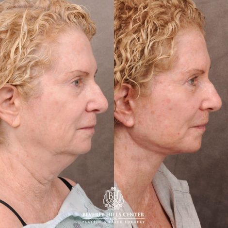 Beverly Hills Center Female Patient Before and After AuraLyft, Upper Blepharoplasty