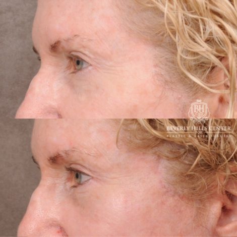 Beverly Hills Center Female Patient Before and After AuraLyft, Upper Blepharoplasty
