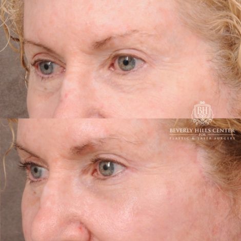 Beverly Hills Center Female Patient Before and After AuraLyft, Upper Blepharoplasty