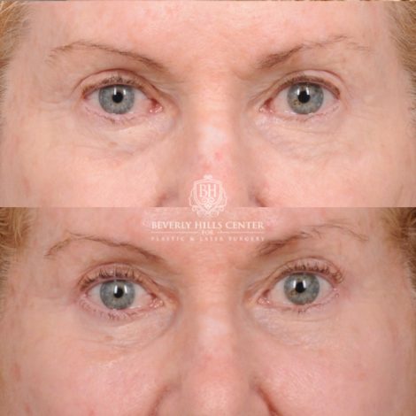 Beverly Hills Center Female Patient Before and After AuraLyft, Upper Blepharoplasty