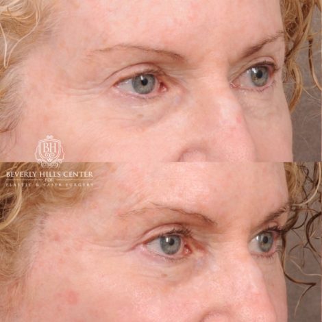 Beverly Hills Center Female Patient Before and After AuraLyft, Upper Blepharoplasty