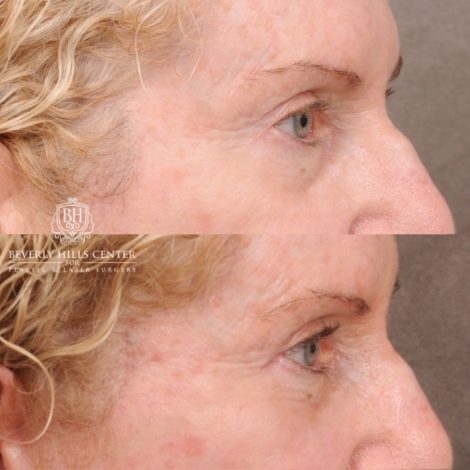 Beverly Hills Center Female Patient Before and After AuraLyft, Upper Blepharoplasty
