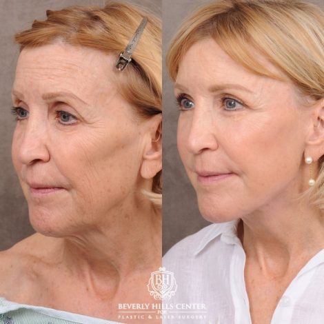 Beverly Hills Center Female Patient Before and After AuraLyft™, Upper Blepharoplasty, and CO2