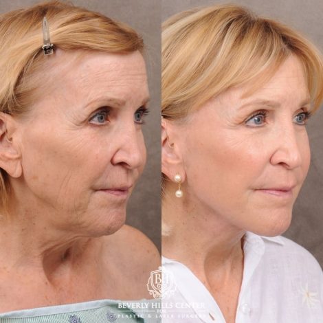 Beverly Hills Center Female Patient Before and After AuraLyft™, Upper Blepharoplasty, and CO2