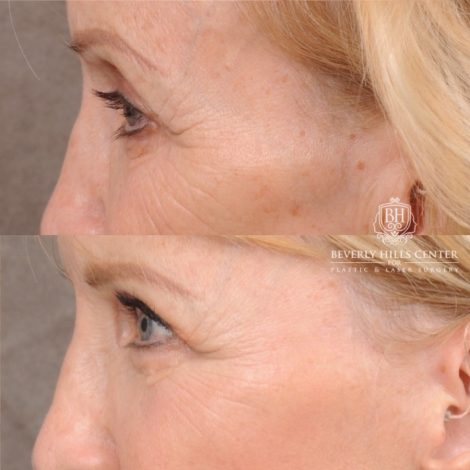Beverly Hills Center Female Patient Before and After AuraLyft™, Upper Blepharoplasty, and CO2
