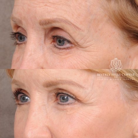 Beverly Hills Center Female Patient Before and After AuraLyft™, Upper Blepharoplasty, and CO2