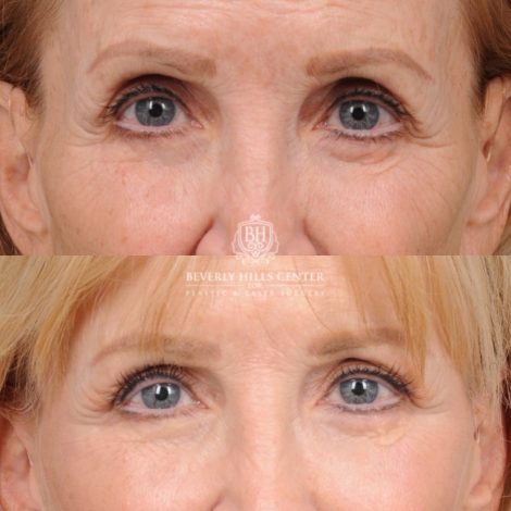 Beverly Hills Center Female Patient Before and After AuraLyft™, Upper Blepharoplasty, and CO2
