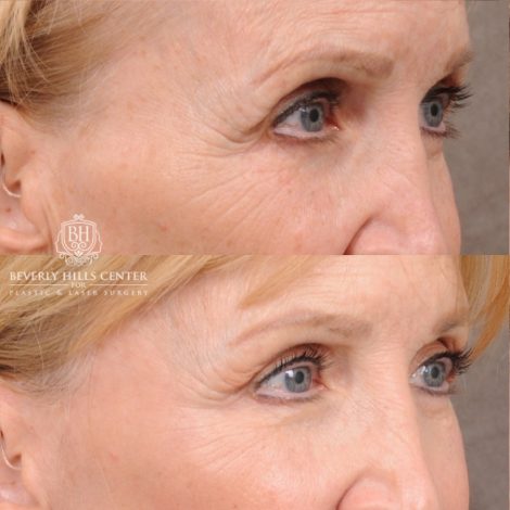Beverly Hills Center Female Patient Before and After AuraLyft™, Upper Blepharoplasty, and CO2