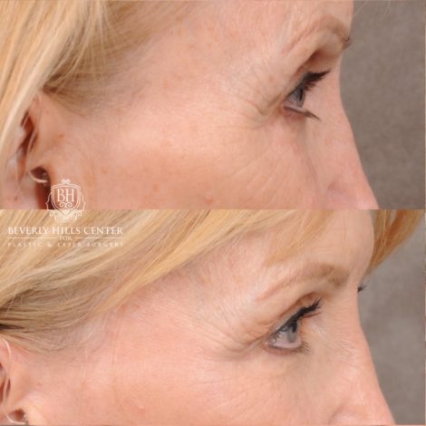 Beverly Hills Center Female Patient Before and After AuraLyft™, Upper Blepharoplasty, and CO2